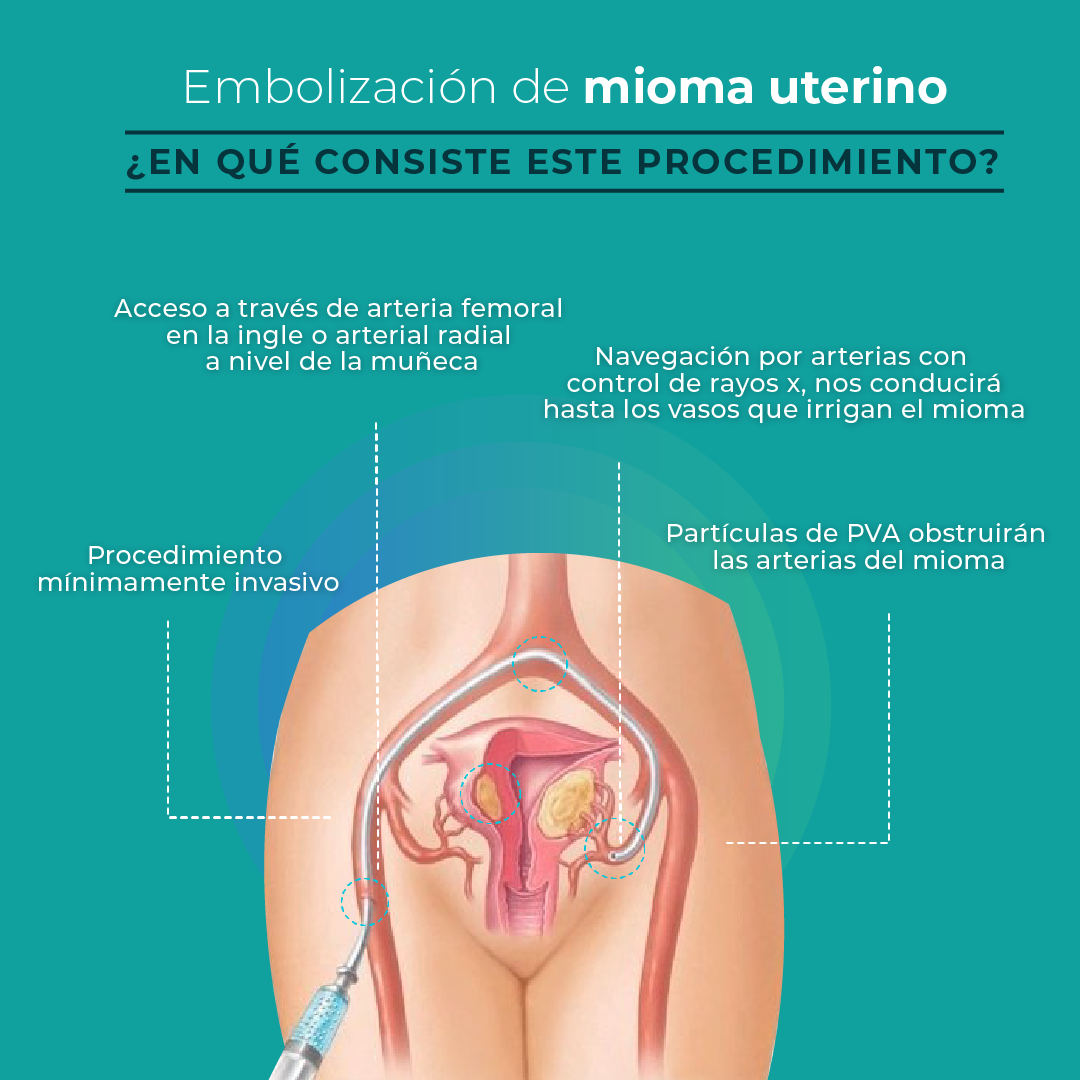 Embolización de mioma uterino