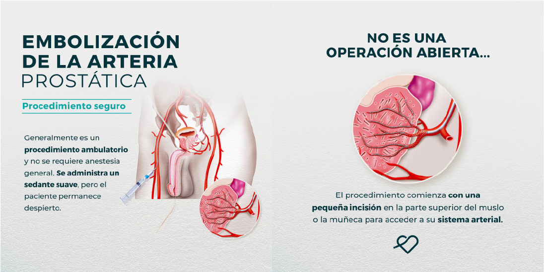 Embolización prostática