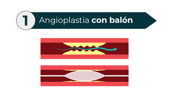 Angioplastia con balón