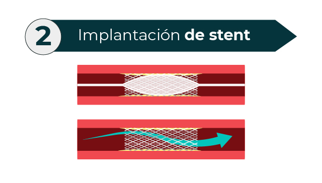 Implantación de stent